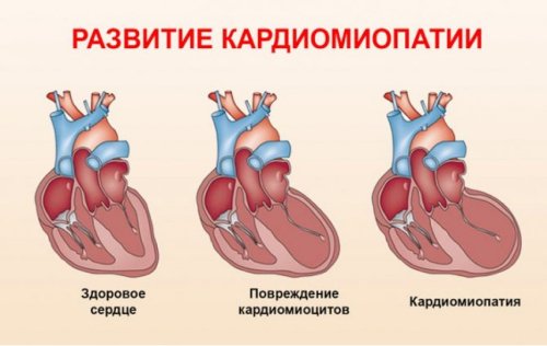 Инфографика сердце алкоголика